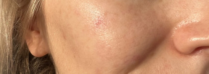 Спасение кожи La Roche-posay Effaclar H Iso-Biome