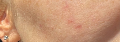 Не зря его хвалят! Лосьон для размягчения и растворения открытых и закрытых комедонов Super Lotion от Holy Land