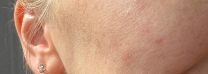 И-де-аль-но! Ампулы MartiDerm The Originals Proteos Hydra Plus