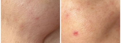 Сыворотка для нового тона кожи La Roche-posay Pure Niacinamide 10 Serum