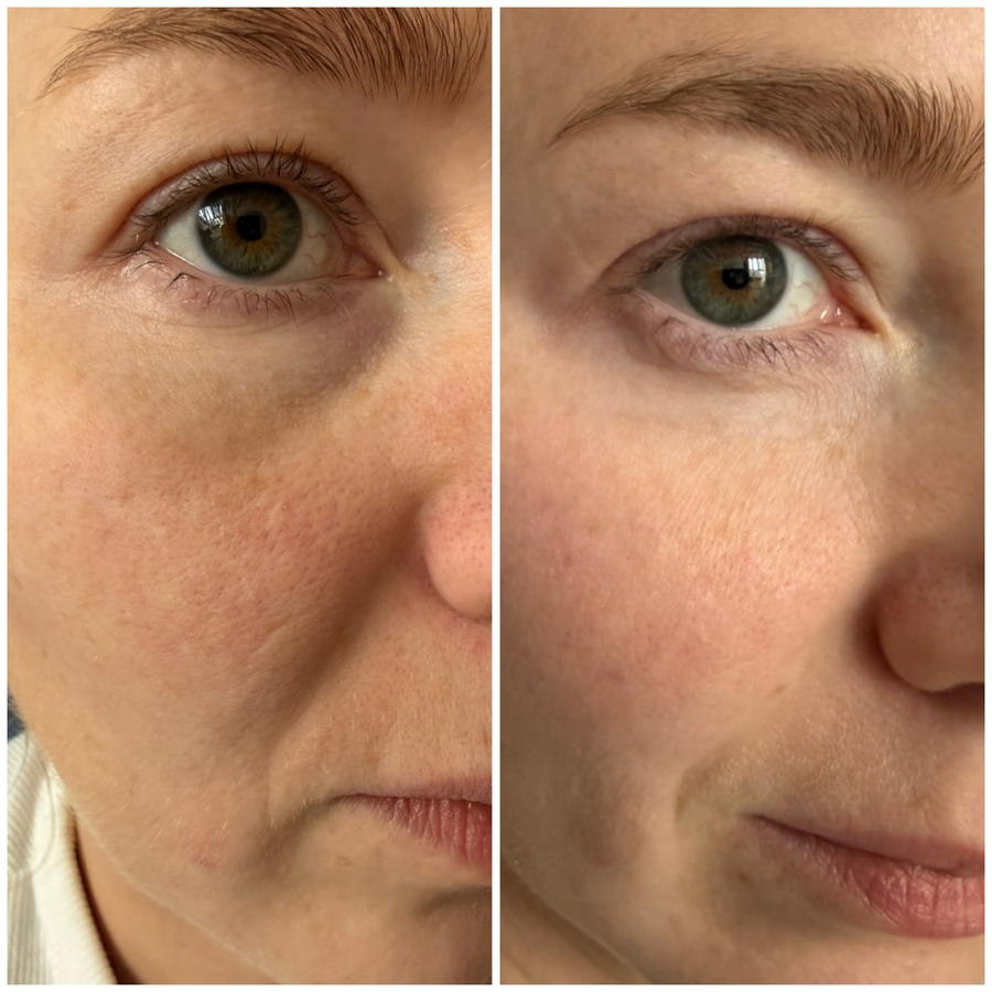 Кожа "перед" и "после" использования пилинга. Фото сделано с разницей в 30 минут.