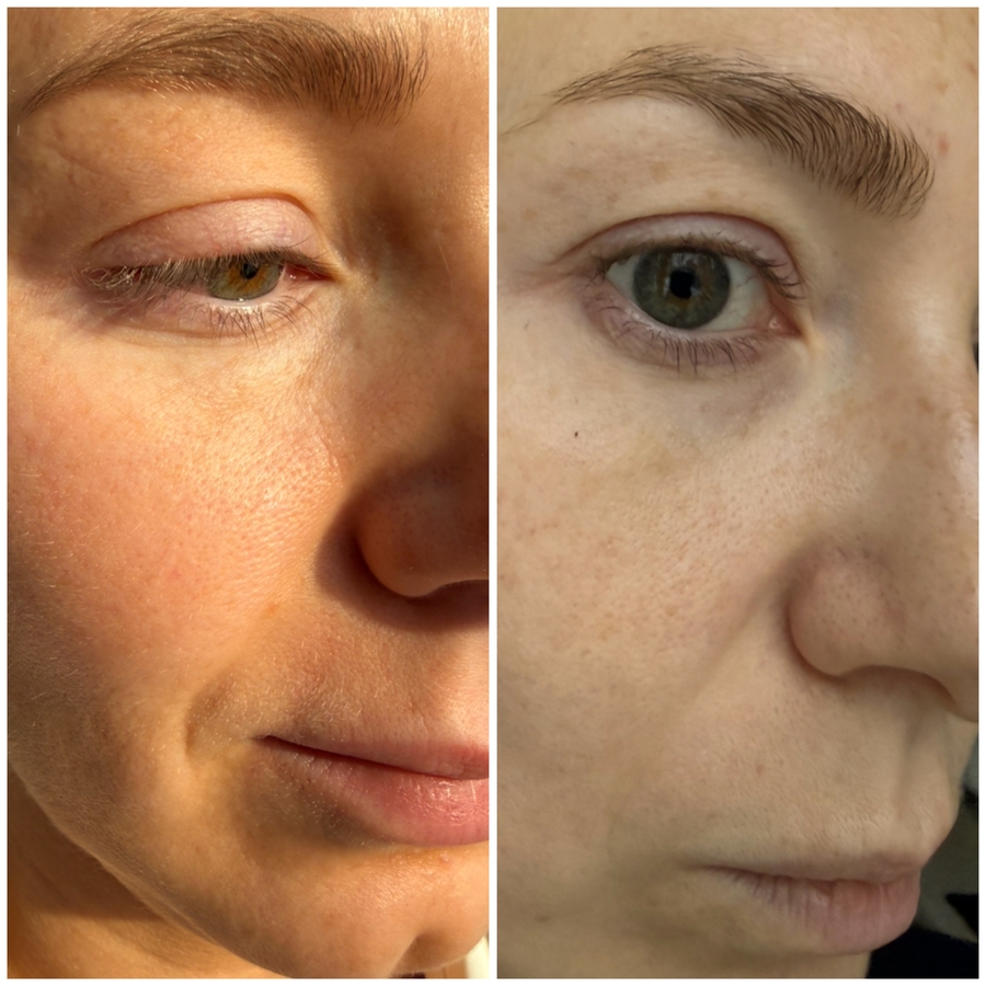 Накопительный эффект: 1 фото -кожа сейчас, 2 фото - конец ноября, кожа без кислот.