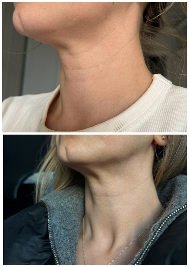 Фото с разницей в месяц. Прошу прощения, не увидела сразу пятно на белой футболке от очищающей маски.