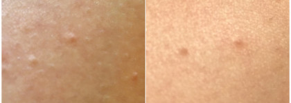 Два средства от вросших волос от Noreva и Skin Doctors