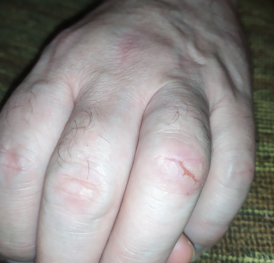 Трескается кожа на пальцах рук, причины, лечение, 6 рецептов масок для рук