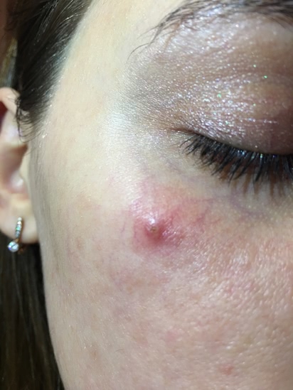 Скорая помощь при воспалении: Guerlain Stop Spot Anti-Blemish Treatment