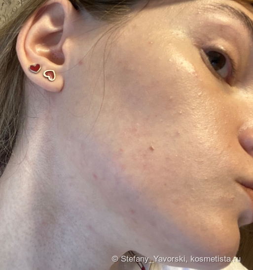 Супергерои для борьбы с комедонами: Sesderma, Camomilla Blu, Manyo