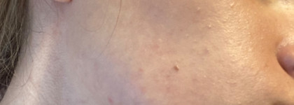 Супергерои для борьбы с комедонами: Sesderma, Camomilla Blu, Manyo