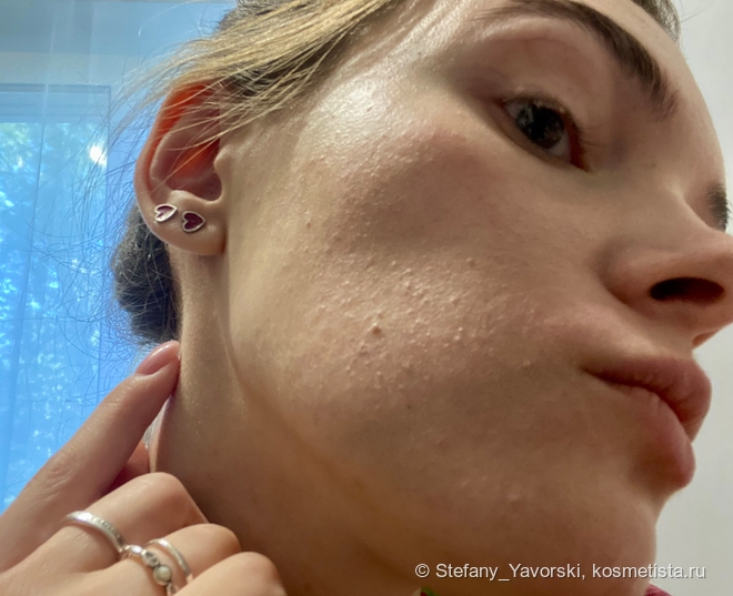 Супергерои для борьбы с комедонами: Sesderma, Camomilla Blu, Manyo