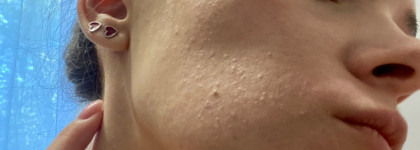 Супергерои для борьбы с комедонами: Sesderma, Camomilla Blu, Manyo