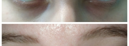 Вождь разнокожих - Патчи с микроиглами с растительным кофеином BLOM Microneedle Eye Patches. (+Затест на мужской коже)