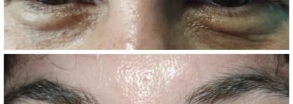 Вождь разнокожих - Патчи с микроиглами с растительным кофеином BLOM Microneedle Eye Patches. (+Затест на мужской коже)