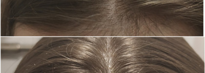 Перхоть forever. "До" и "после" действительно стоящих и натуральных средств по её укрощению от Chocolatte