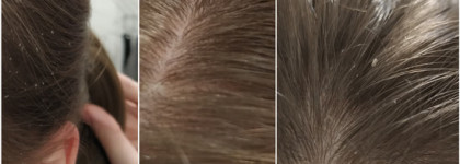 Перхоть forever. "До" и "после" действительно стоящих и натуральных средств по её укрощению от Chocolatte