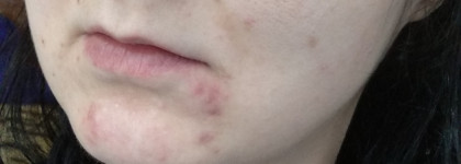 Предохраняюсь от подкожников тонерами