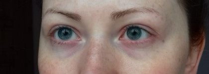 Убираем отеки при помощи патчей LA MISO Marine Collagen Hydrogel Eye Patch