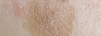 Как я с пигментацией боролась после лазерной процедуры с помощью косметических средств