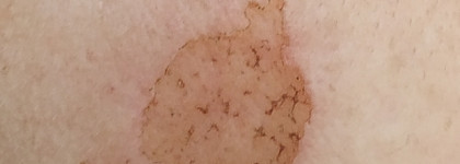 Как я с пигментацией боролась после лазерной процедуры с помощью косметических средств