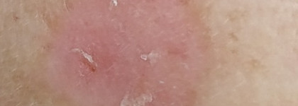 Как я с пигментацией боролась после лазерной процедуры с помощью косметических средств