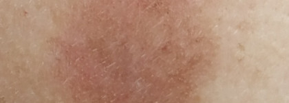 Как я с пигментацией боролась после лазерной процедуры с помощью косметических средств