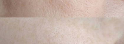 Сужающий поры лосьон для глубокого очищения проблемной кожи Vichy Normaderm Purifying Pore-Tightening Lotion
