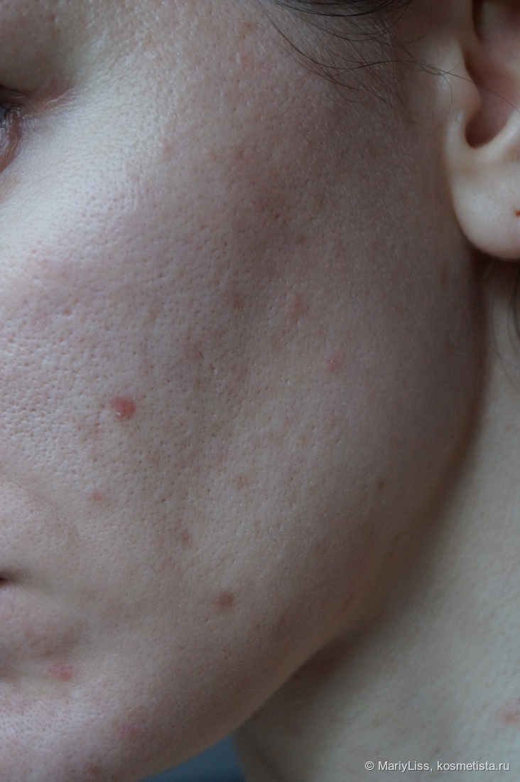 Спустя месяц использования линейки Antibac.