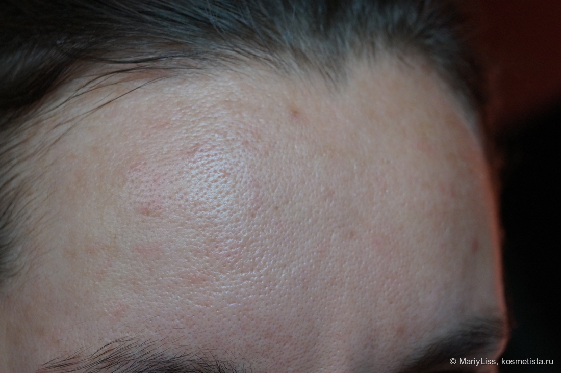 Лоб с уходом - азелаиновая кислота на ночь, La Roche-Posay Effaclar K (+) эмульсия корректирующая, для жирной кожи утром.