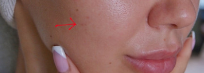 The Оrdinary Lactic Acid 10% + HA 2% - Делиться находками -это +1 к карме