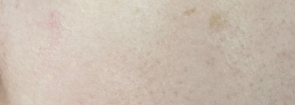 Сыворотка против пигментации Celimax Pore+Dark Spot Brightening Serum. Результат до/после