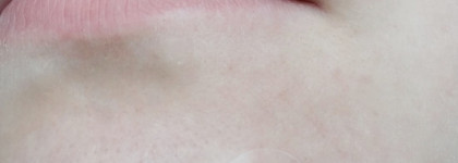 Патчи от прыщей Missha Speedy Solution anti-trouble patch set. Наглядная демонстрация результата