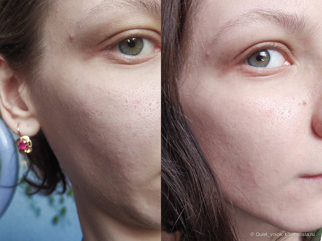 Dnkbeauty Тонер say no to acne эффект