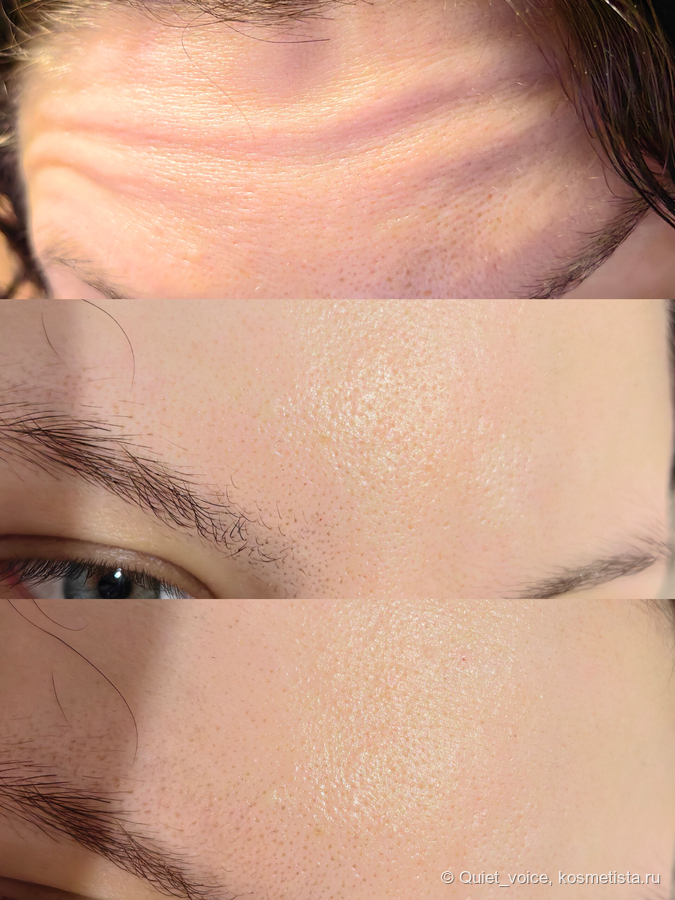 С какого возраста следует колоть морщины? Как ведет себя лицо и сколько занимает восстановление? Мой процесс заживления и итоговое лицо.