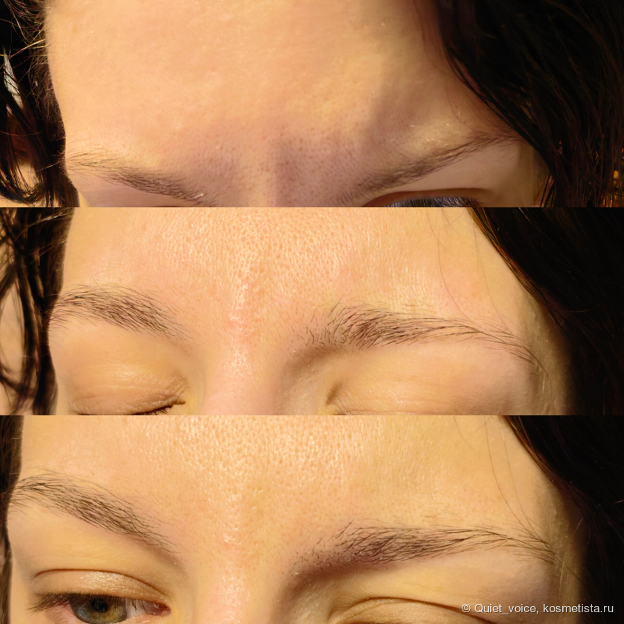 С какого возраста следует колоть морщины? Как ведет себя лицо и сколько занимает восстановление? Мой процесс заживления и итоговое лицо.