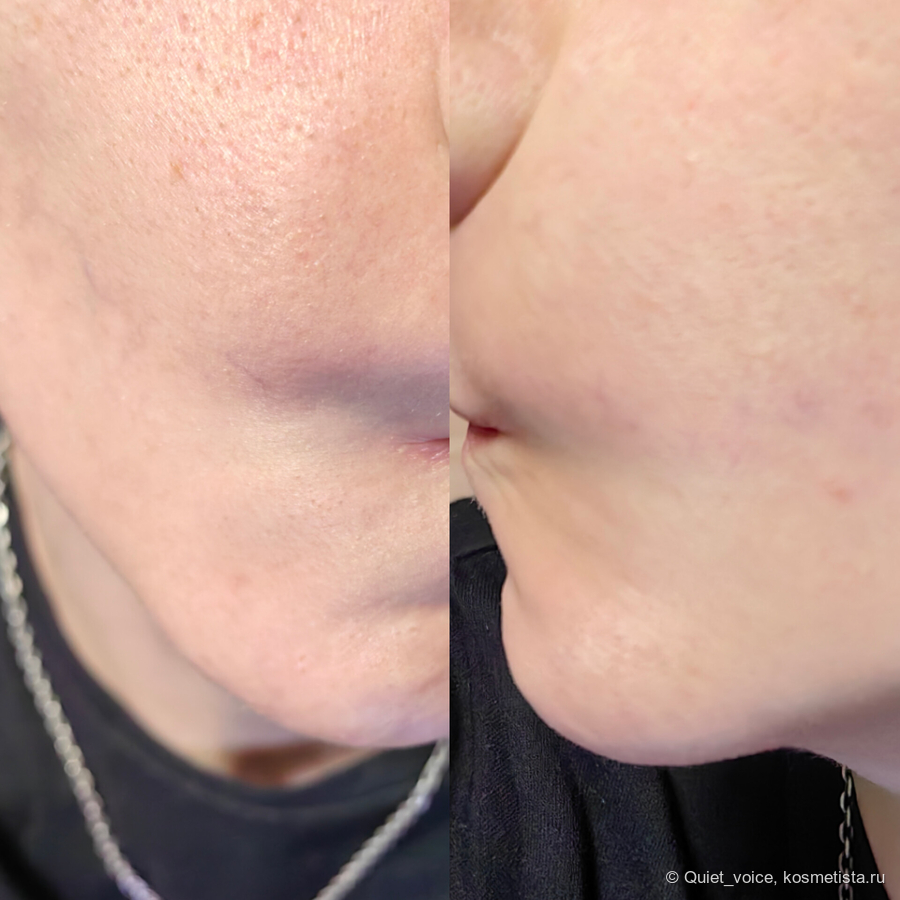 С какого возраста следует колоть морщины? Как ведет себя лицо и сколько занимает восстановление? Мой процесс заживления и итоговое лицо.