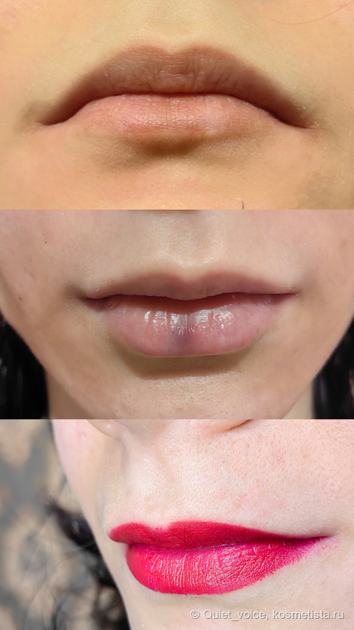 Филлеры в лицо - угол челюсти, подбородок, скулы и губы