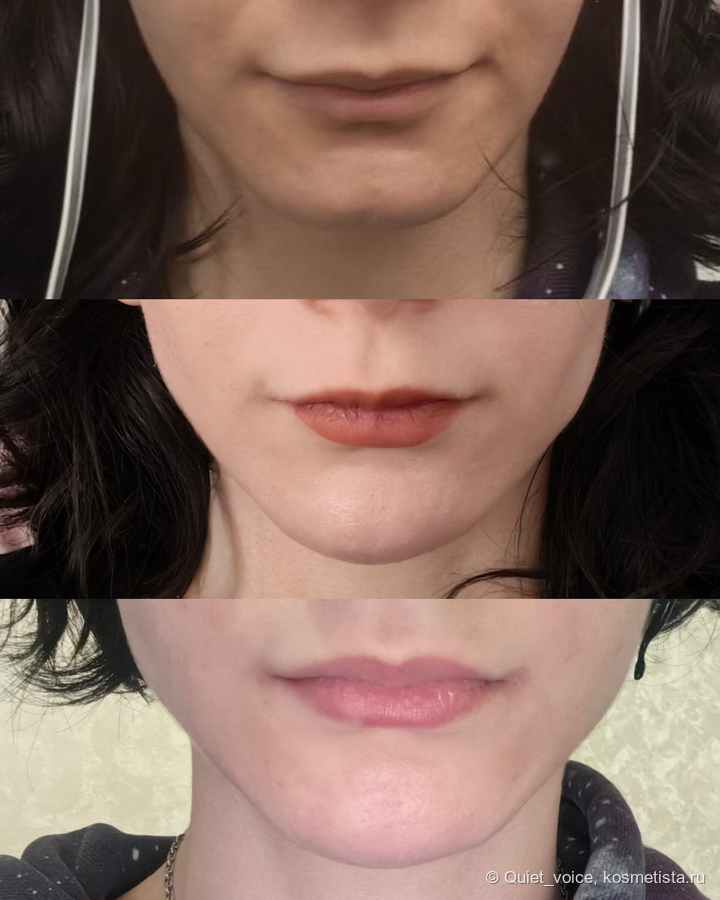 Филлеры в лицо - угол челюсти, подбородок, скулы и губы
