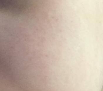 Фото через 6 месяцев после лечения