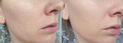 Лечебный макияж для проблемной кожи с La Roche- Posay Effaclar Duo(+) Unifant