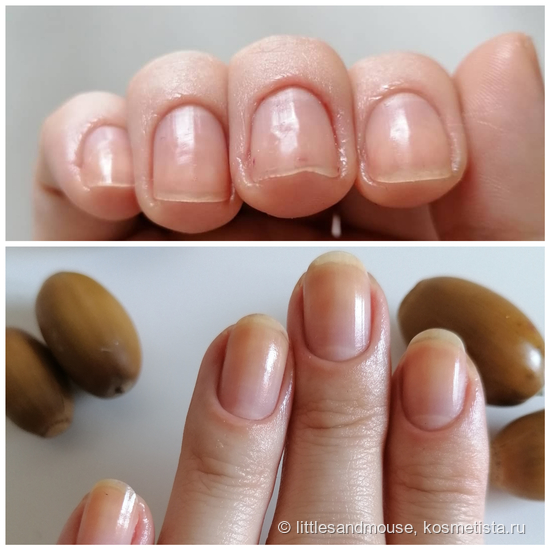 Как вылечить мягкие ногти?