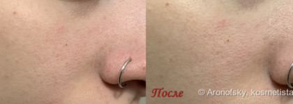 Пузырьковое недоразумение. Тканевая маска Glamglow Bubblesheet Oxygenating Deep Cleanse Mask