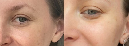 Моя "до-посляшка" по пигментным пятнам: отчет пятимесячных втираний