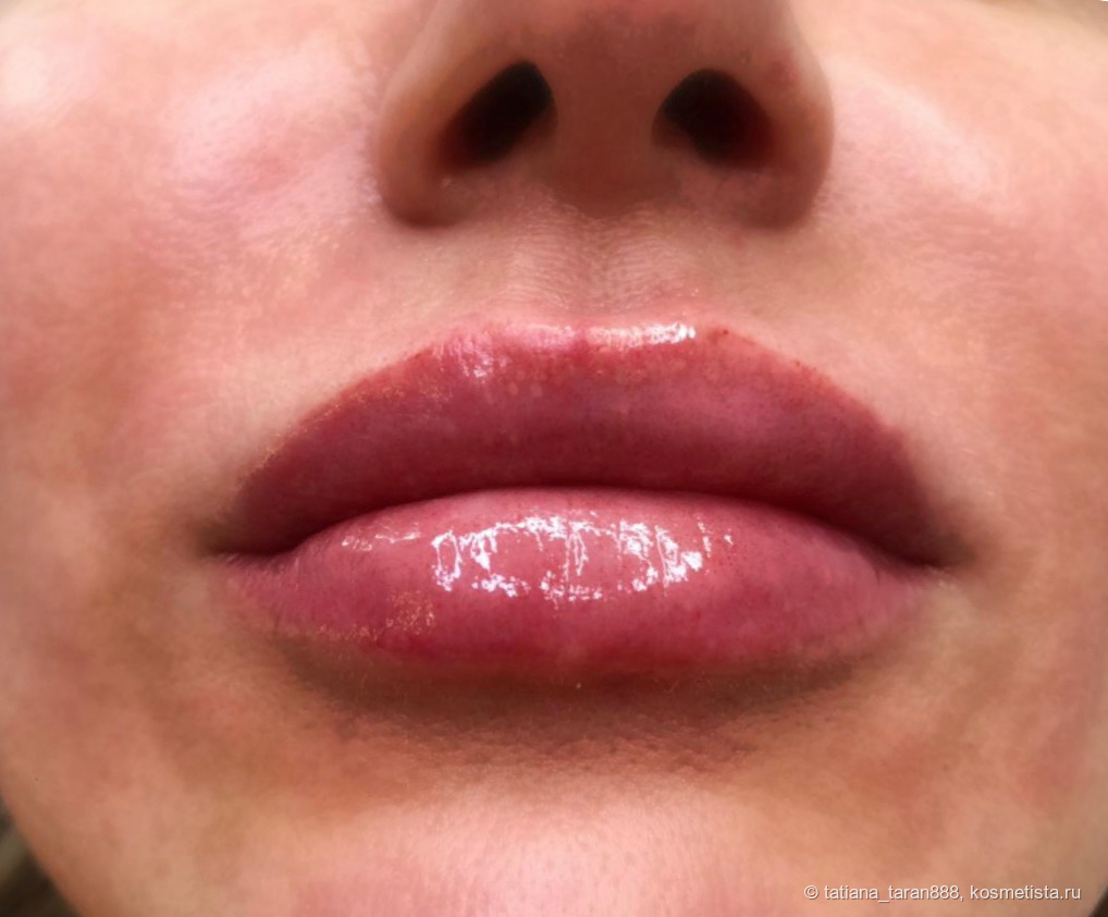 А вот так губы выглядят сразу после процедуры