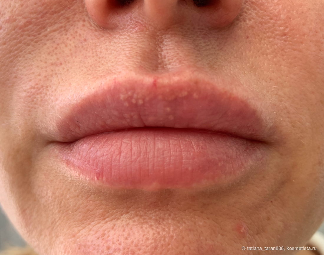 Вот так выглядят губы после процедуры, спустя 3 недели