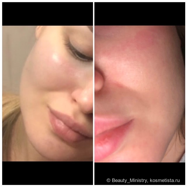 На первом фото кожа сразу ПОСЛЕ нанесения концентрата, а на втором ДО