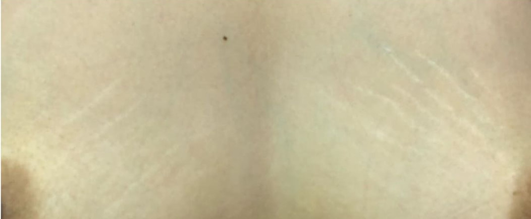 Как я боролась с растяжками