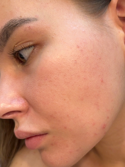 Мой идеальный ретиналь: Don’t Touch My Skin Retinal