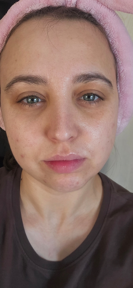 Вот тут хорошо видна разница, тут нанесен бальзам только на левую часть лица.