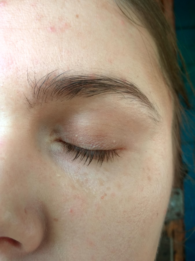 Эмульсия на подвижном веке