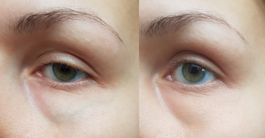 Слева: кожа без макияжа, справа: Cover FX Correct Click Peach