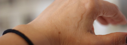 Гель-сыворотка Vichy Mineral 89 для повышения иммунитета кожи после лечения прыщей до/после